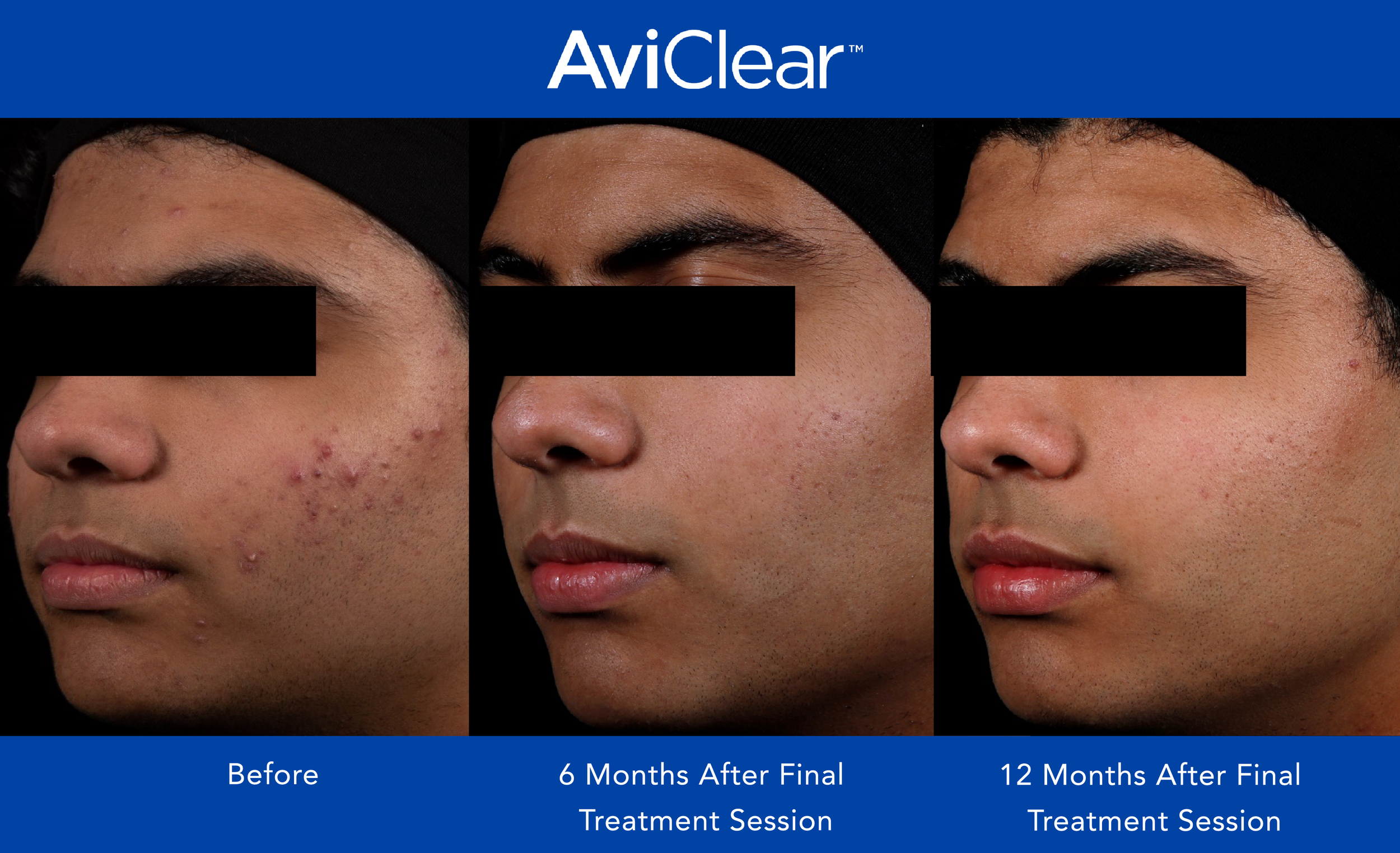 AviClear Before and After _12 month_4.png