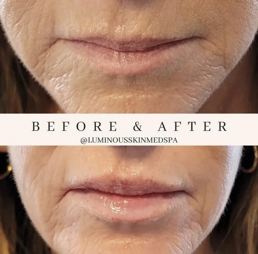 filler lip injections