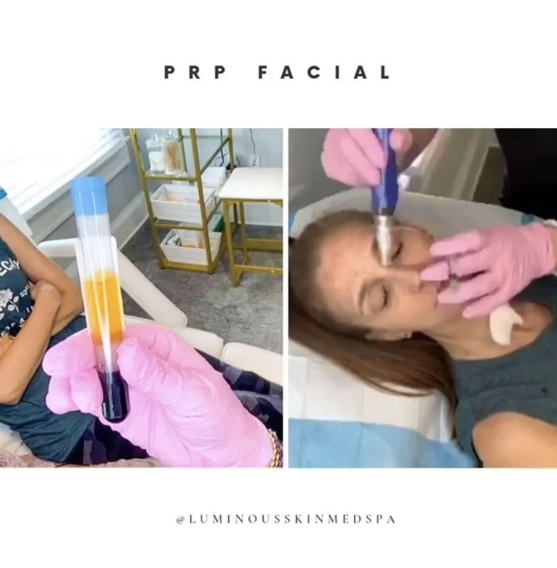 platelet rich plasma (PRP)