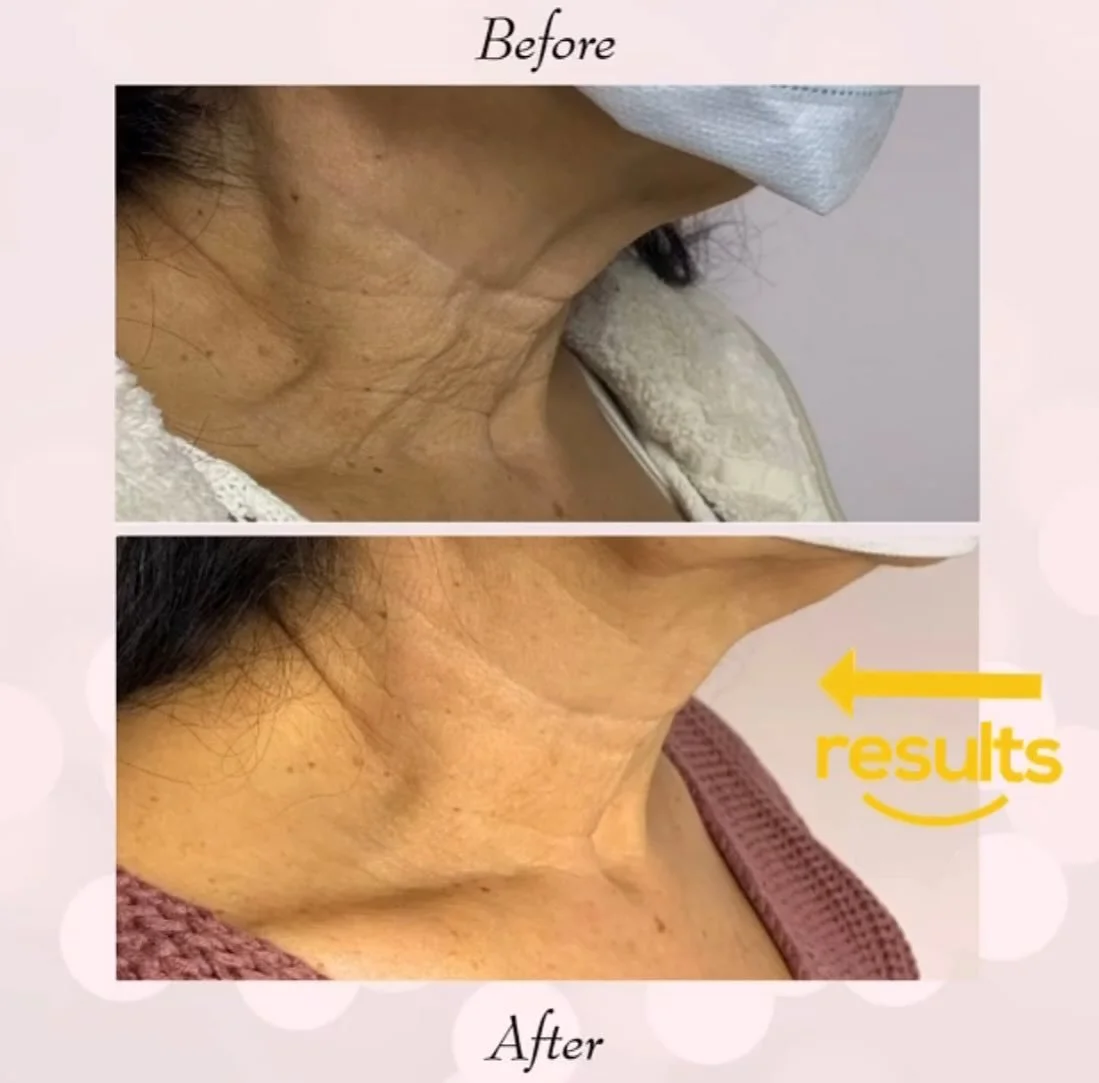 ✨ Smooth. Renew. Transform. ✨
Our Sublative&trade; treatment by Candela Medical uses fractionated radiofrequency technology to stimulate collagen and resurface the skin &mdash; with minimal downtime. Perfect for improving:
✔ Fine lines &amp; wrinkles