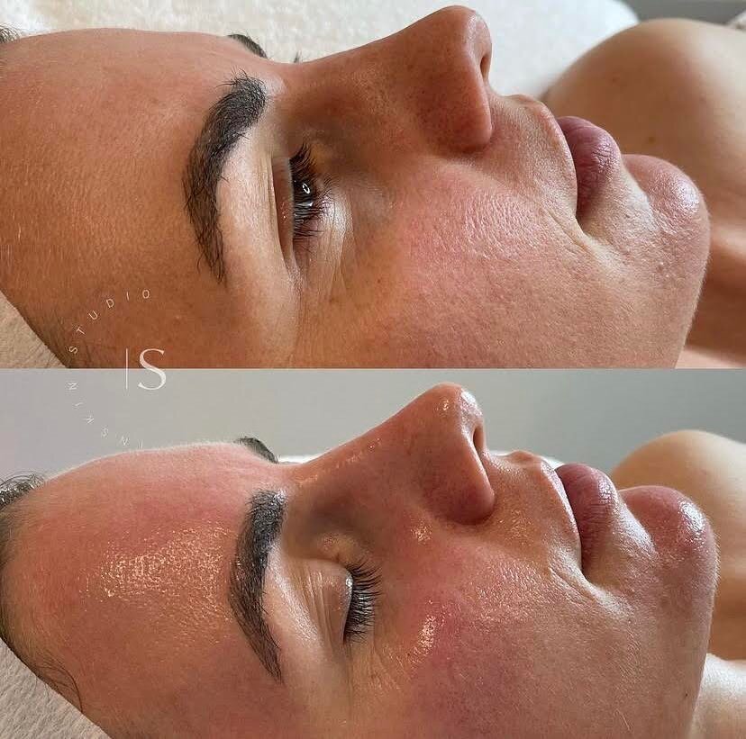 Have you seen our most recent reel?&nbsp;💭

We show you what to expect during a hydrafacial appointment in the studio, but we thought we should show you a little close up of before and after the actions

Will you be booking a hydrafacial appointment