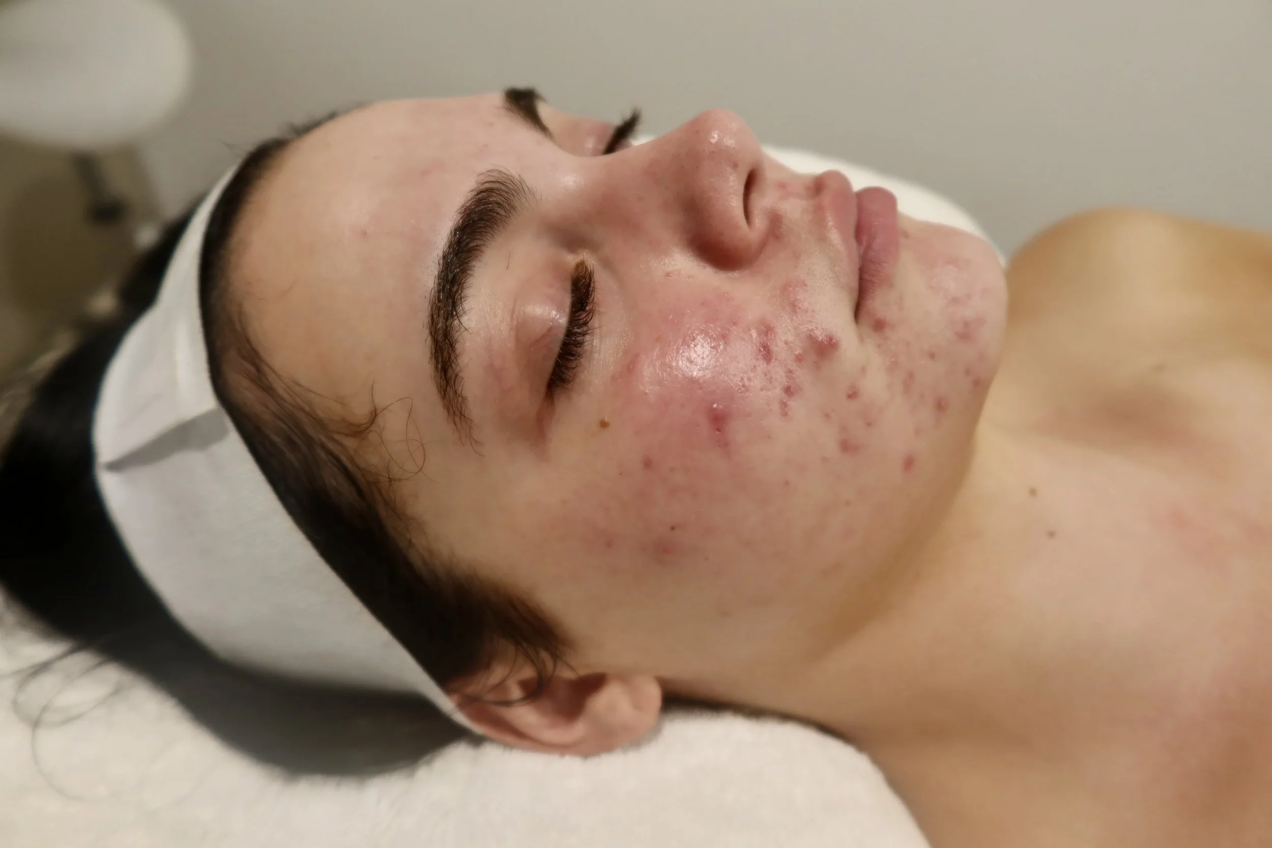 Acne Before Photo.JPG