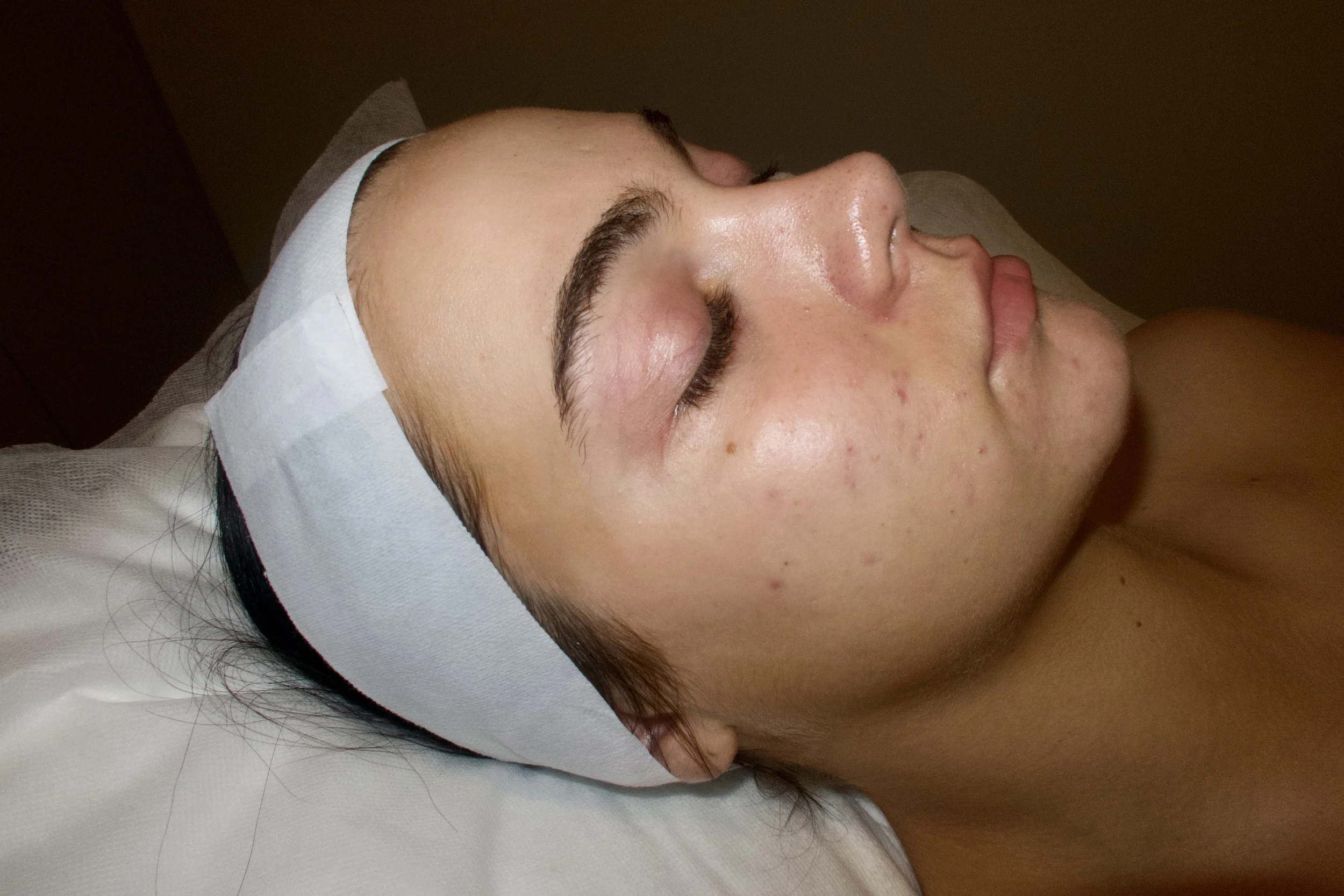 Acne After Photo .jpeg