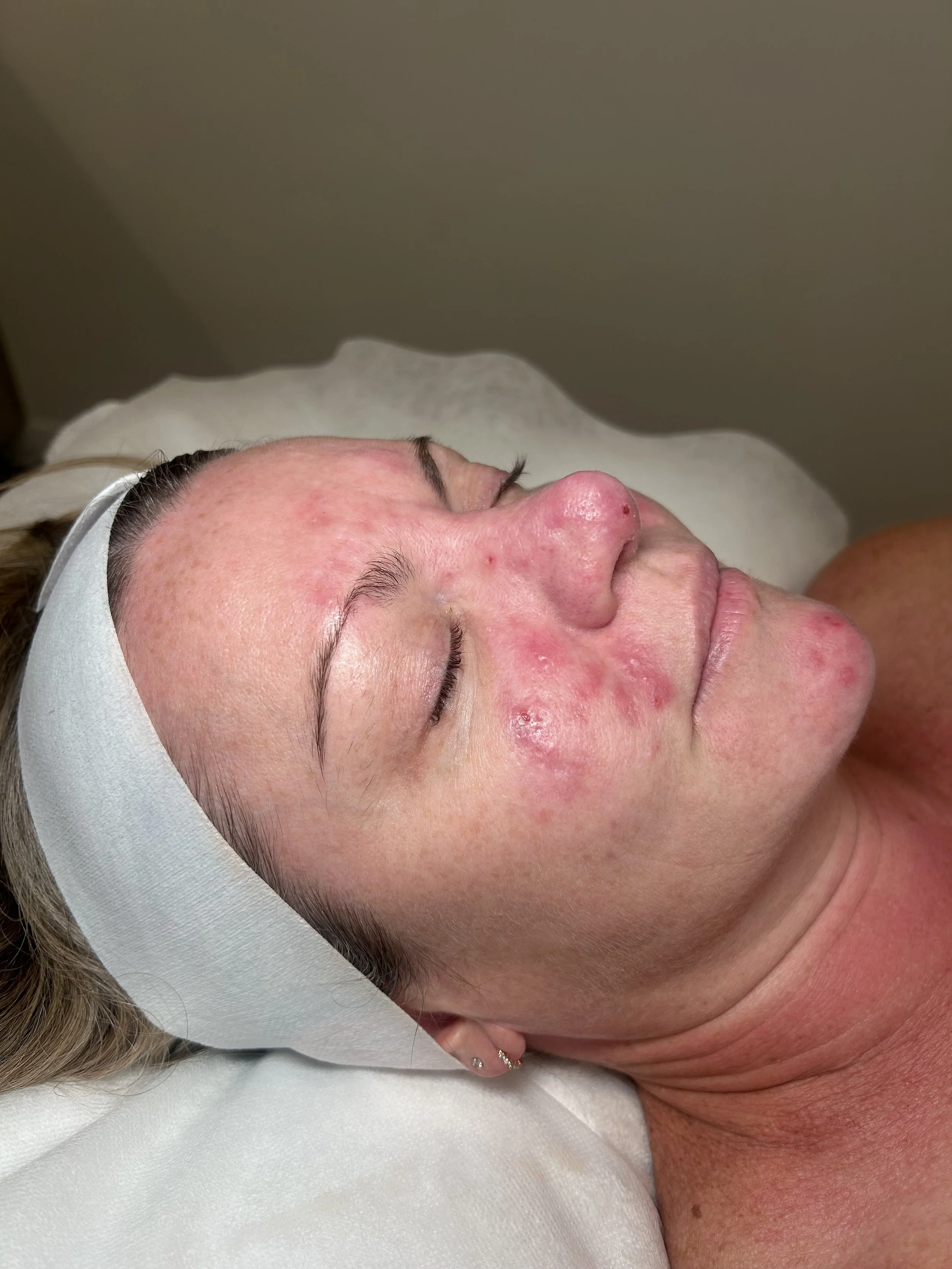 Rosacea Before Photo.jpeg