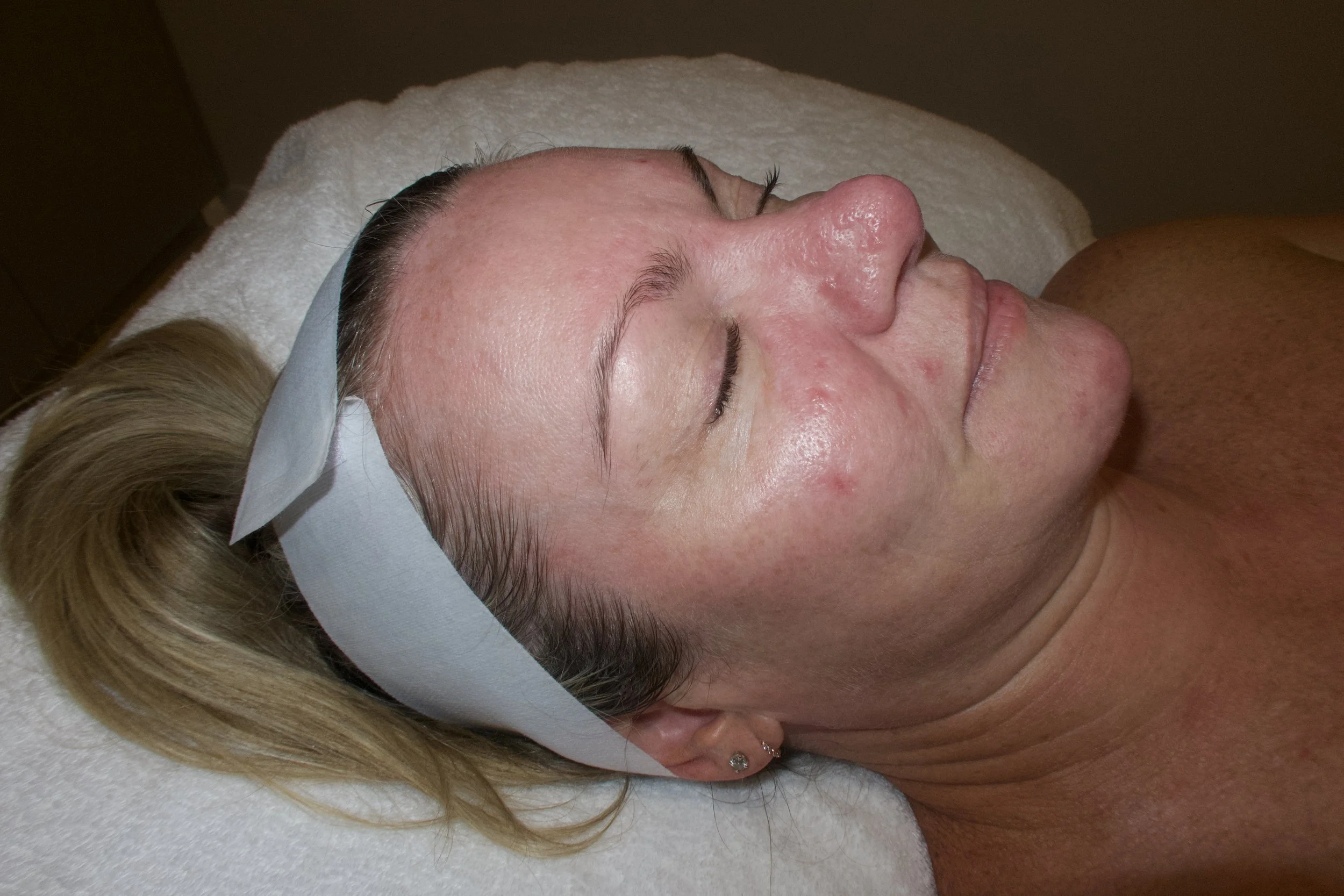 Rosacea After Photo.jpeg