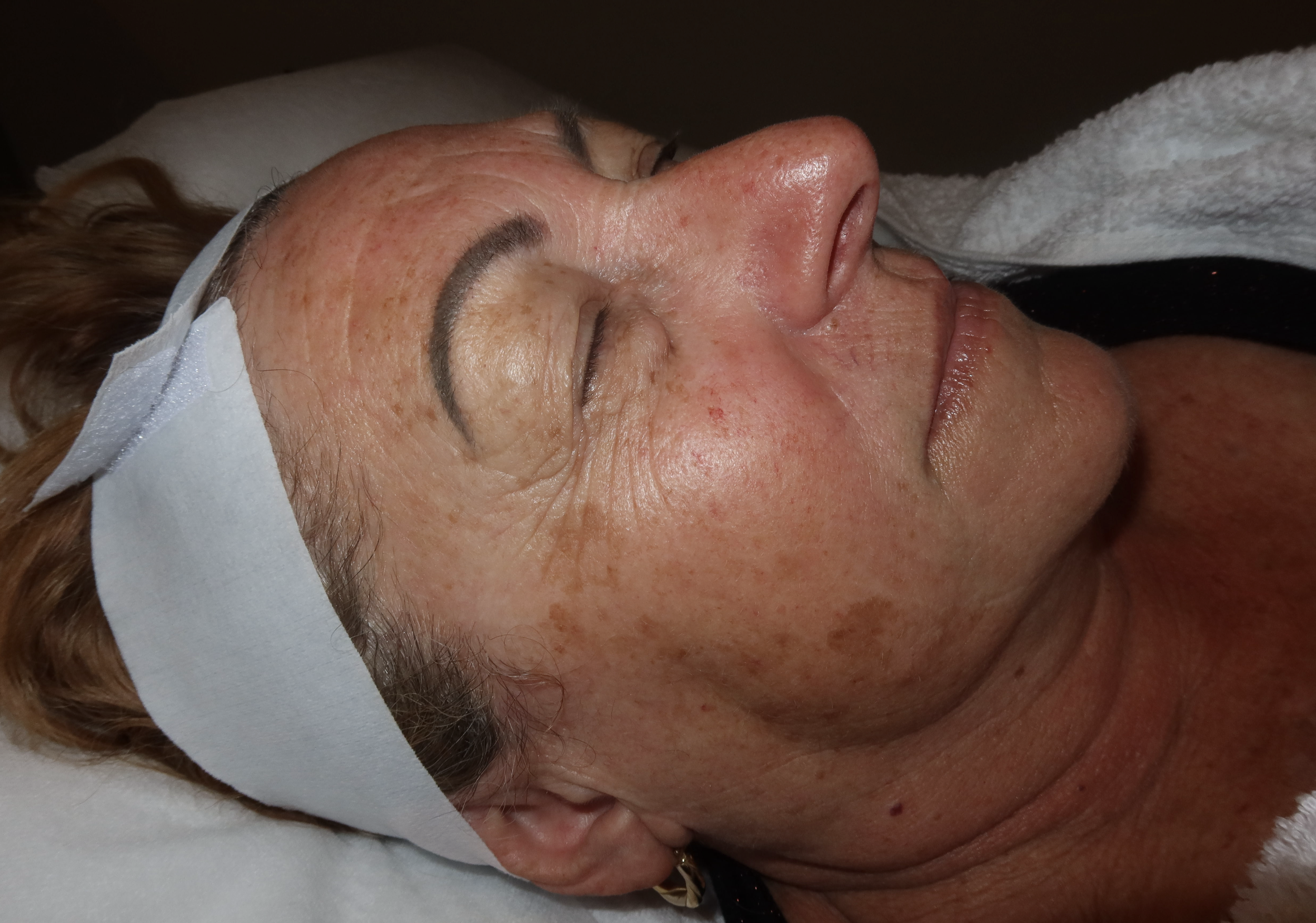 Before IPL pigment and vascular R side .png