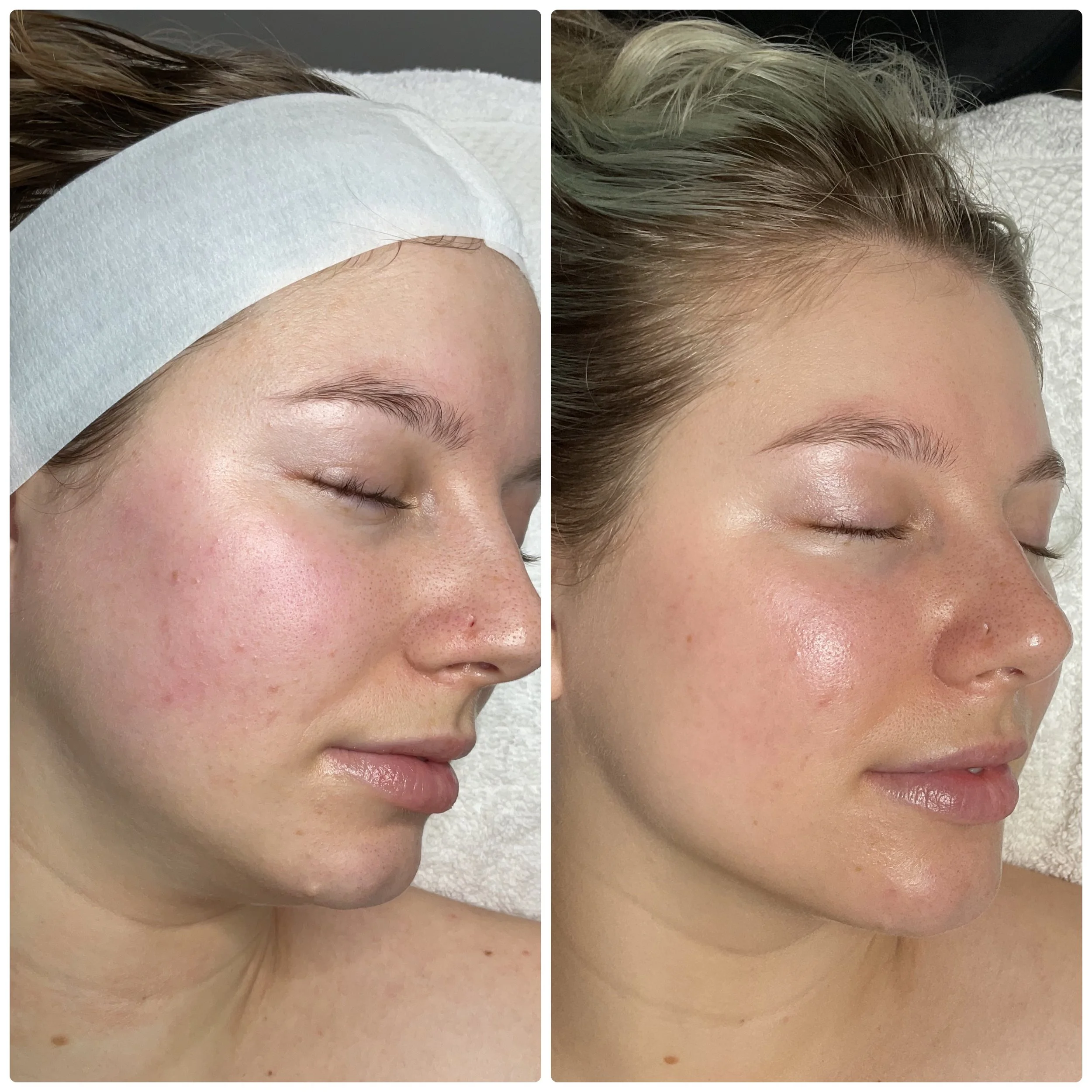 Side-by-side before and after images of a woman showing improvement in skin clarity and texture, with the casual setting suggesting a skincare or cosmetic treatment.