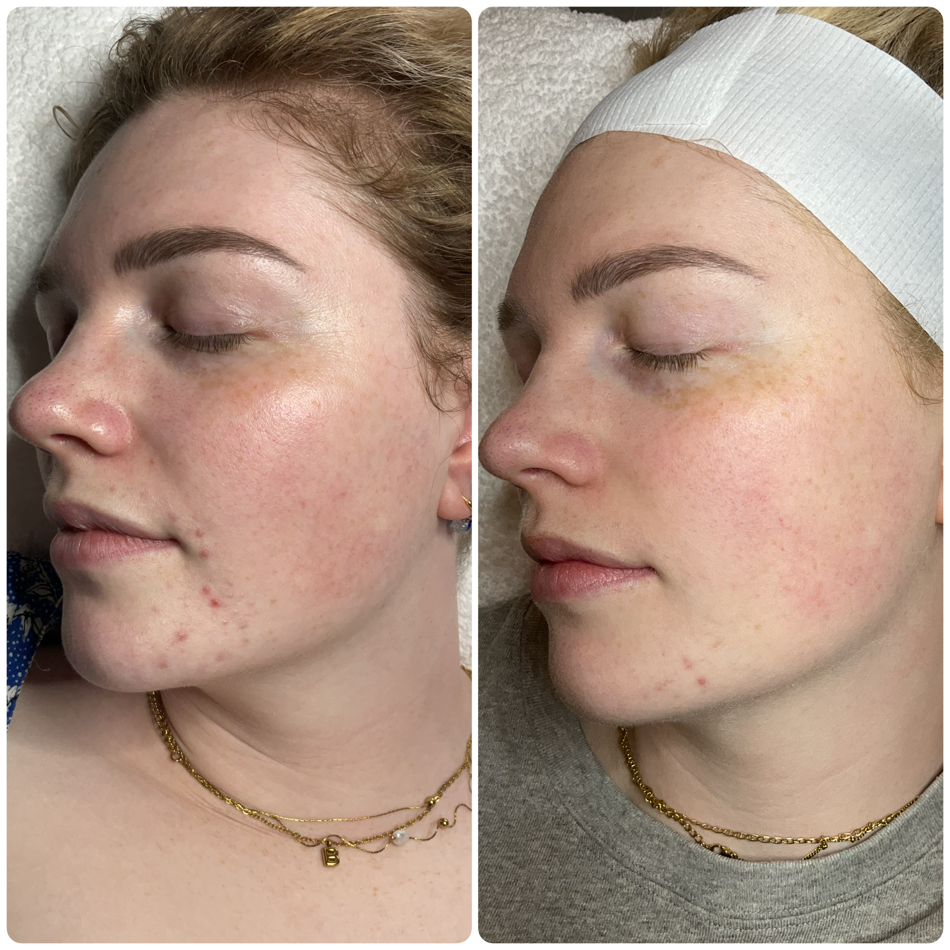 Acne treatment before and after results at MiSkin Auckland showing clearer skin and improved texture