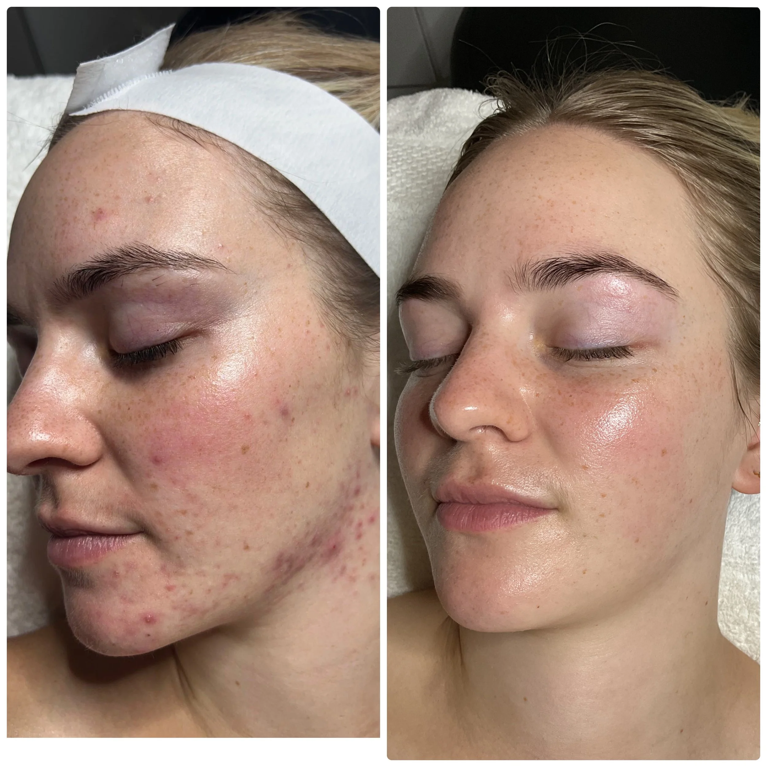 Side-by-side comparison of a woman's face before and after skincare treatment, showing improved skin clarity, reduced redness and acne, with a shiny, smooth complexion after treatment.