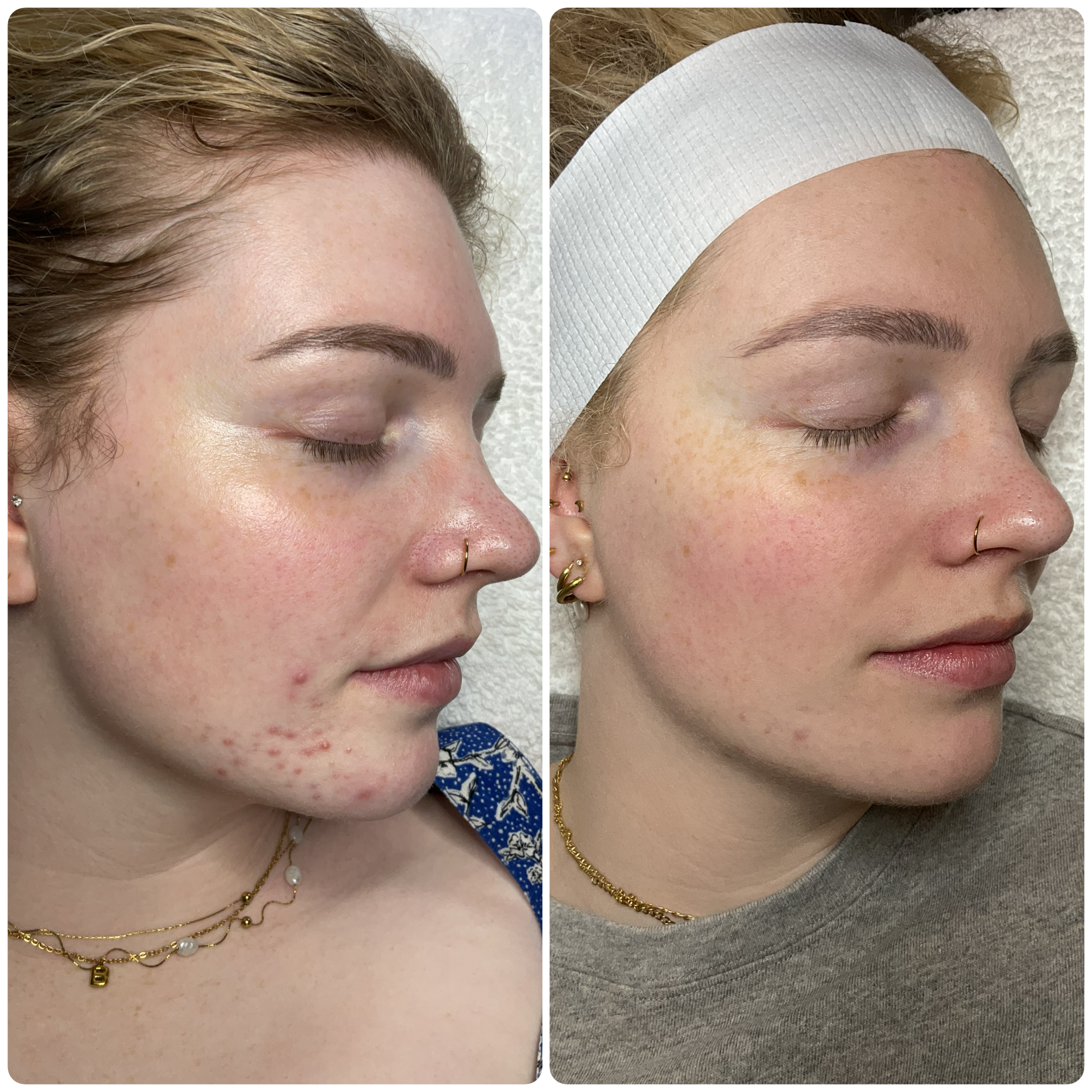 Acne treatment before and after results at MiSkin skin clinic Newmarket Auckland
