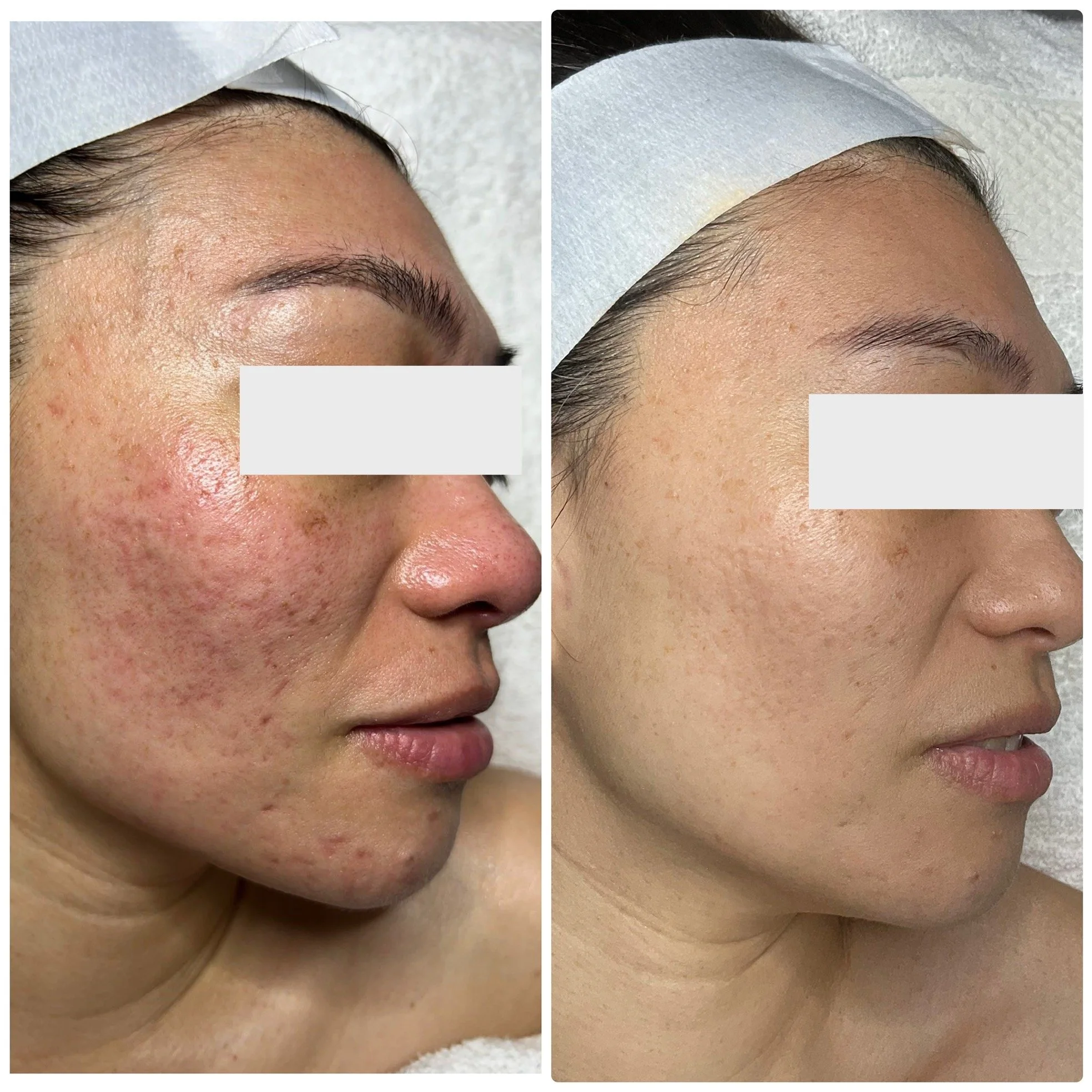 Before and After (microneedling)