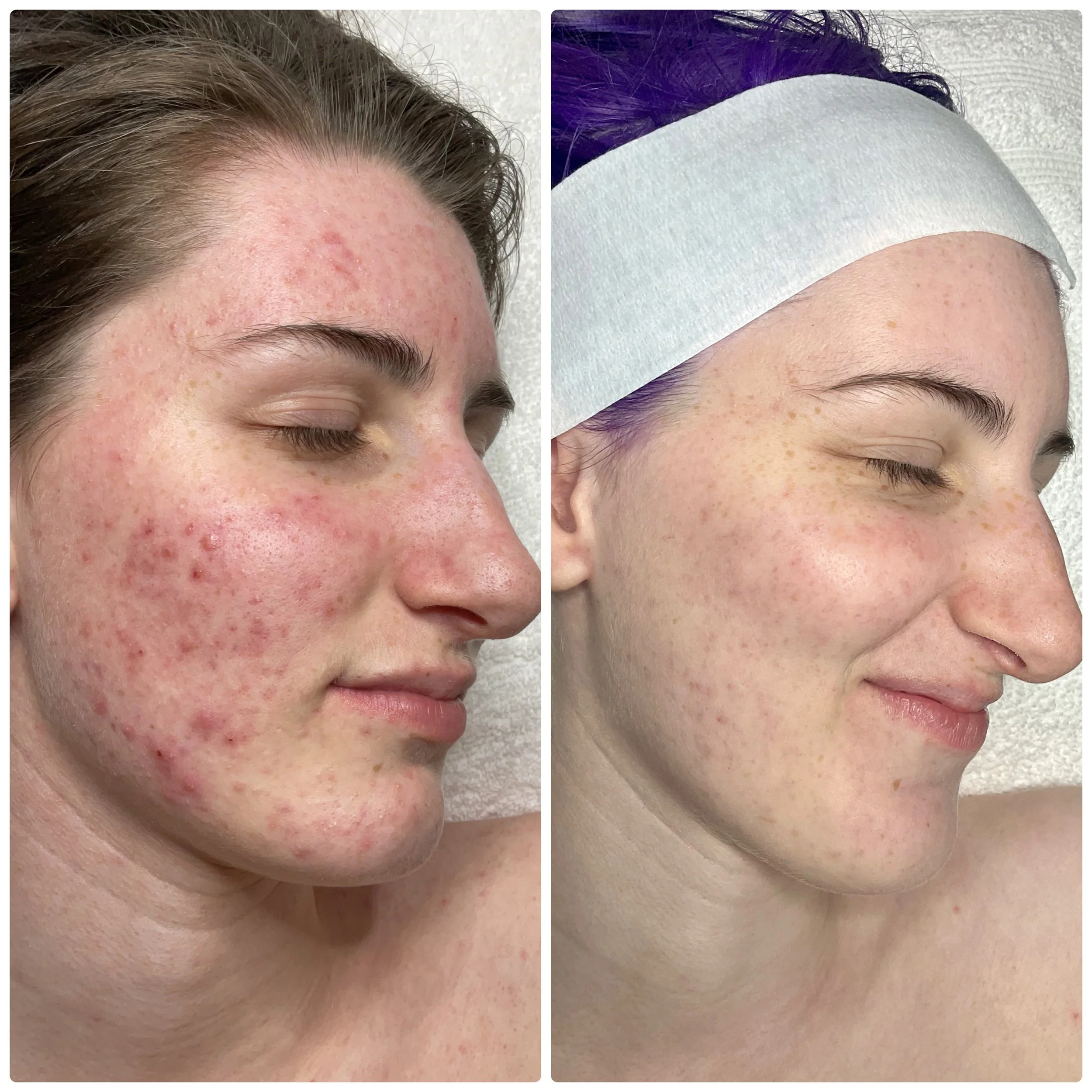Before and After (acne)