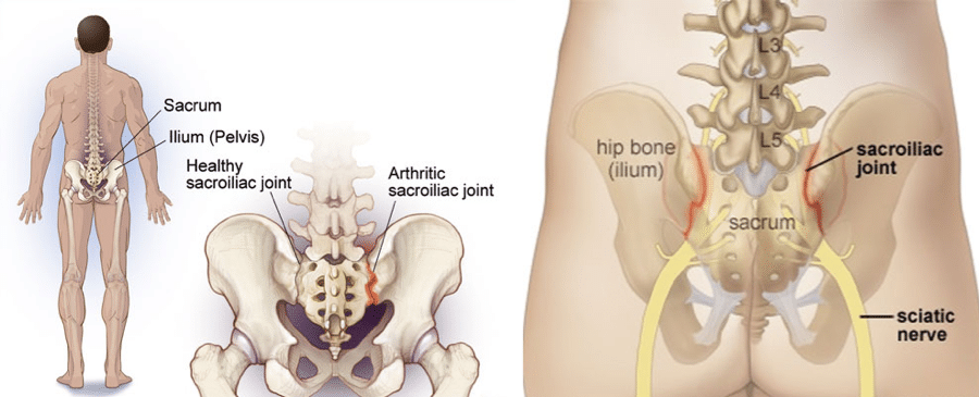 Slagskib cyklus Barnlig Is it Sciatica or SI joint pain? — Proactive Pelvic Health Centre