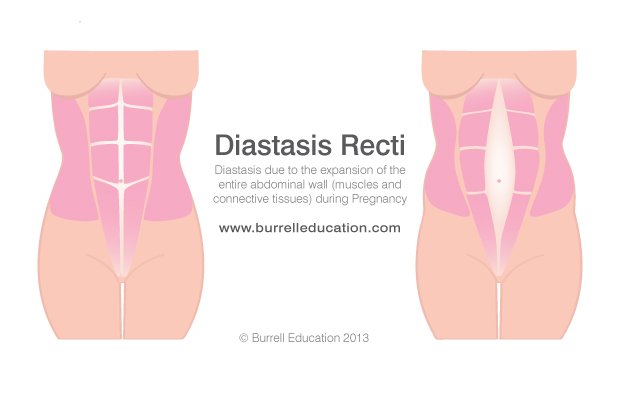 Understanding Diastasis Rectus Abdominus (DRA) - Toronto — Proactive Pelvic  Health Centre