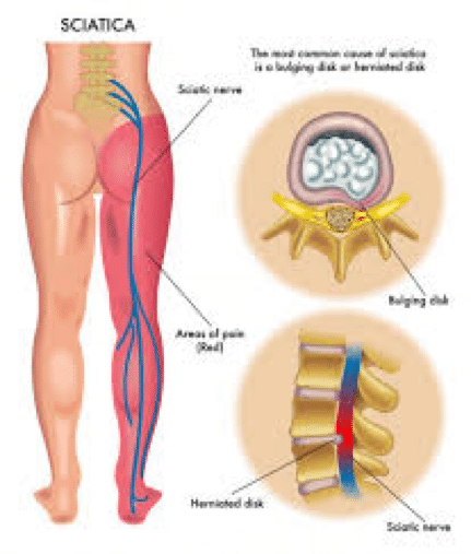 Slagskib cyklus Barnlig Is it Sciatica or SI joint pain? — Proactive Pelvic Health Centre