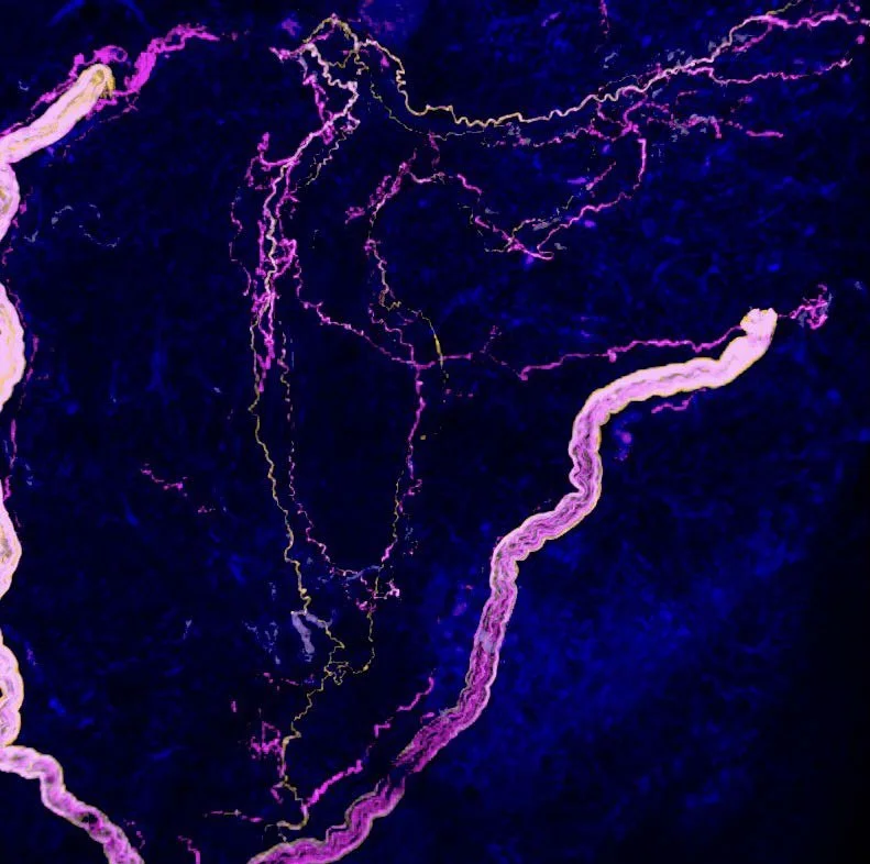 Tumor innervation and anti-tumor immunity