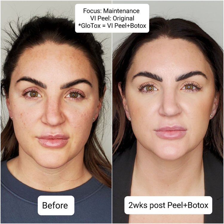 VI peels before and after 2.jpeg