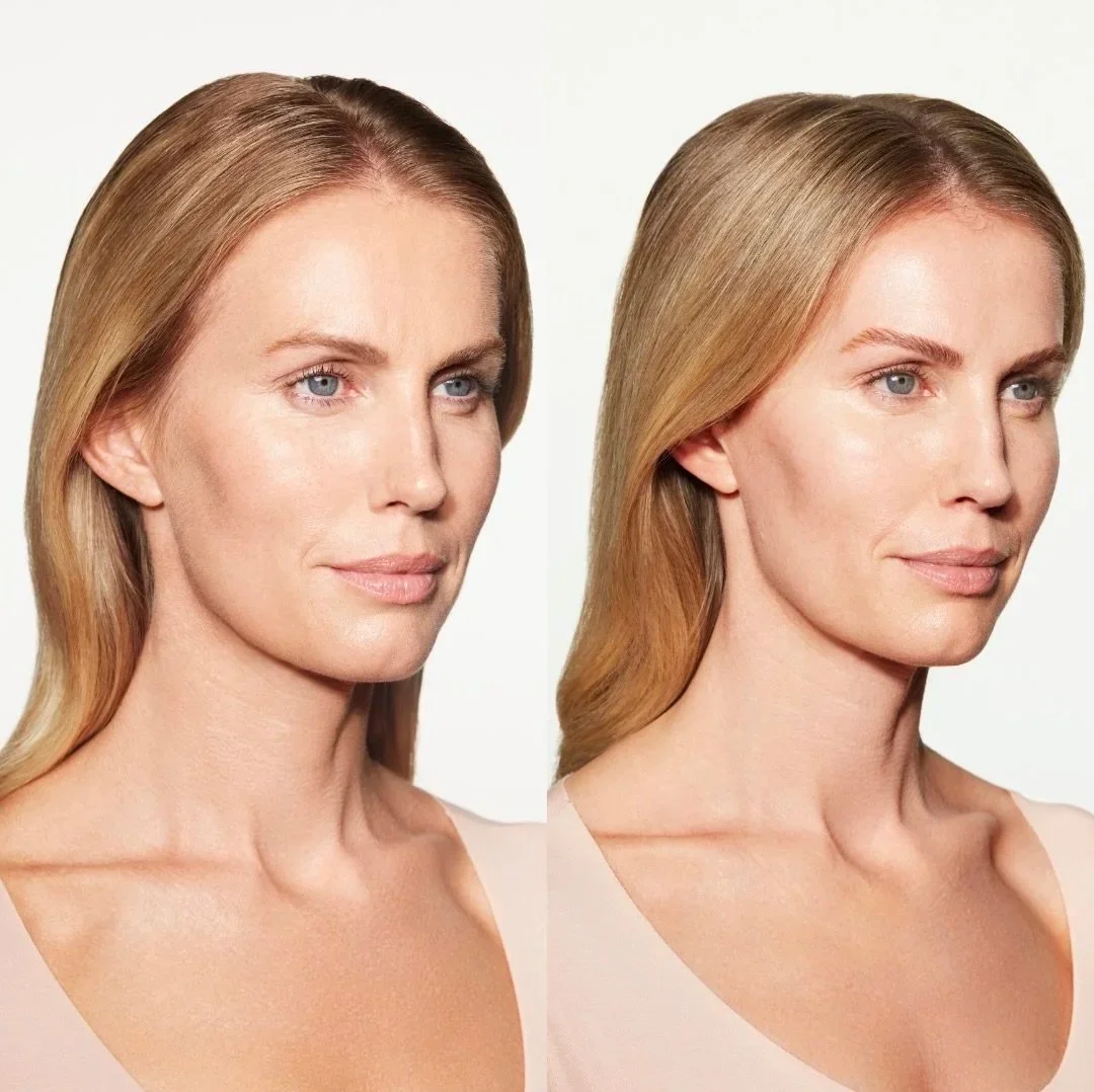 Sculptra at HAUS – A July Deal You Don't Want to Miss