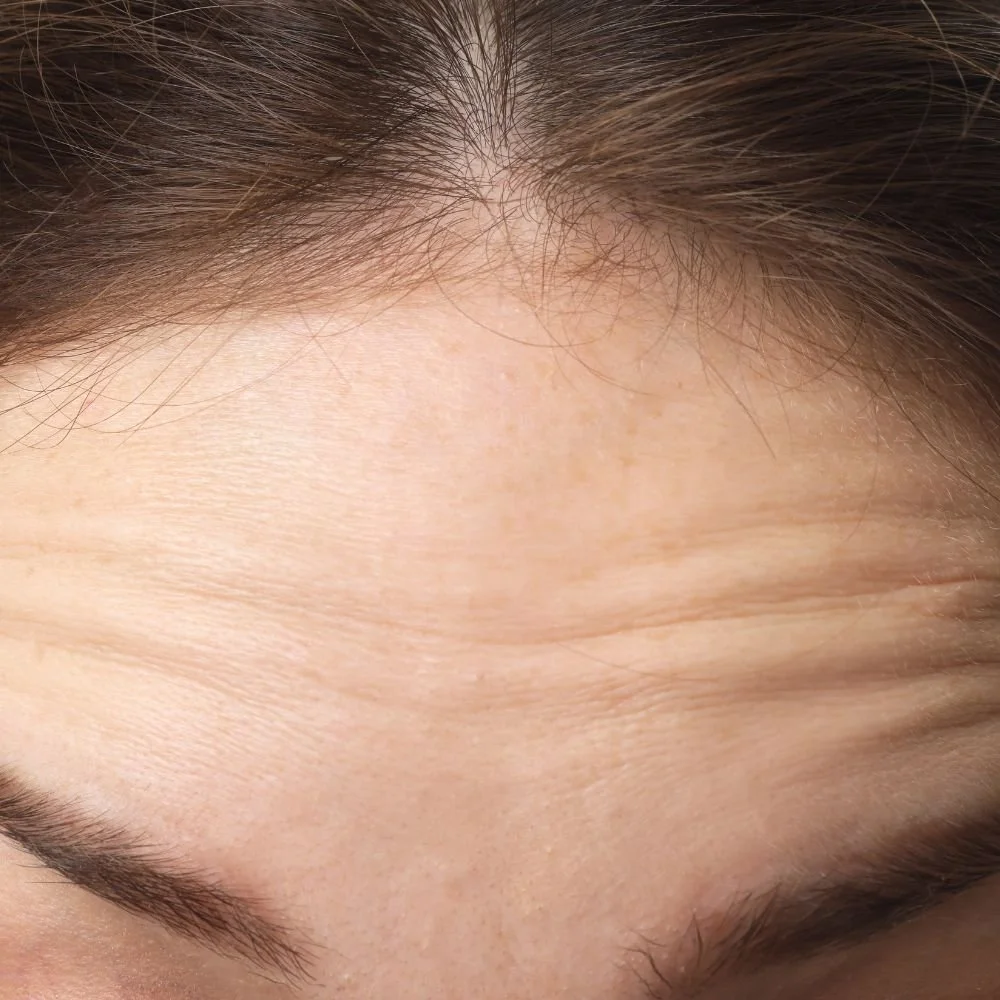 BOTOX treatment for woman with forehead lines and frown
