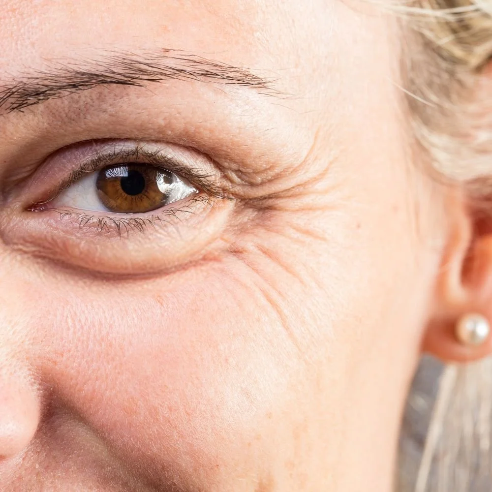 BOTOX treatment for woman with crow's feet near her eyes