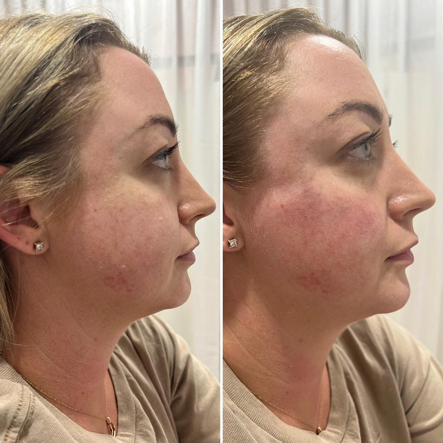 Are you wanting a defined side profile? 

Have you heard of the Esthetic Plane?

When we look at what is &ldquo;ideal&rdquo; and what we are looking to find, it really is about symmetry and balance. 

Dr Robert Ricketts was able to define a specific 