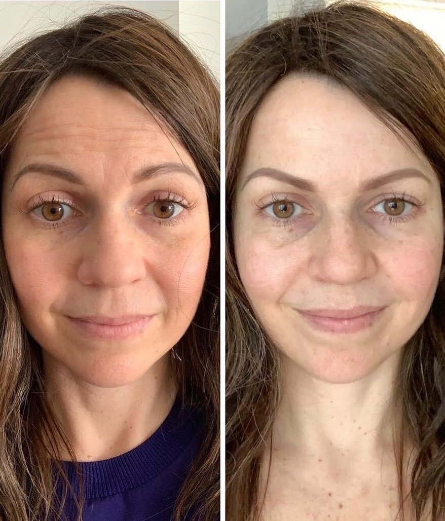 Before and After of a little anti-wrinkle to the forehead lines.

This muscle is the only muscle that raises our eyebrows, so it is very important to not over correct this area as it may then feel a little heavy. 

Evenly spreading the anti wrinkle o