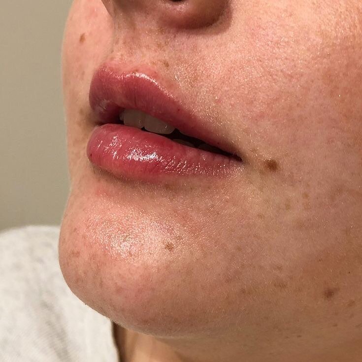 Lips to Love

A stunning result for the gorgeous lady.

Small amounts of dermal filler placed in the top and bottom lip to achieve this result. 

Love a soft natural result.