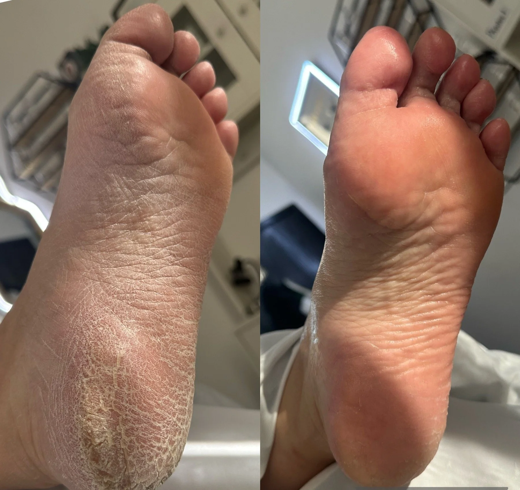 MEDI PEDI - FOOT RESURFACING