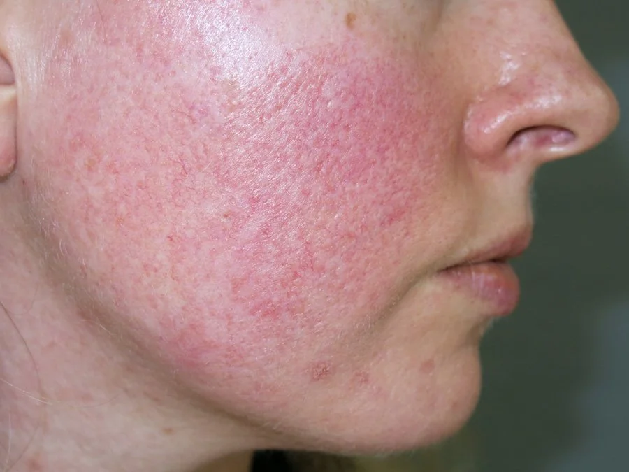 Erythematotelangiectatic rosacea (Subtype 1)