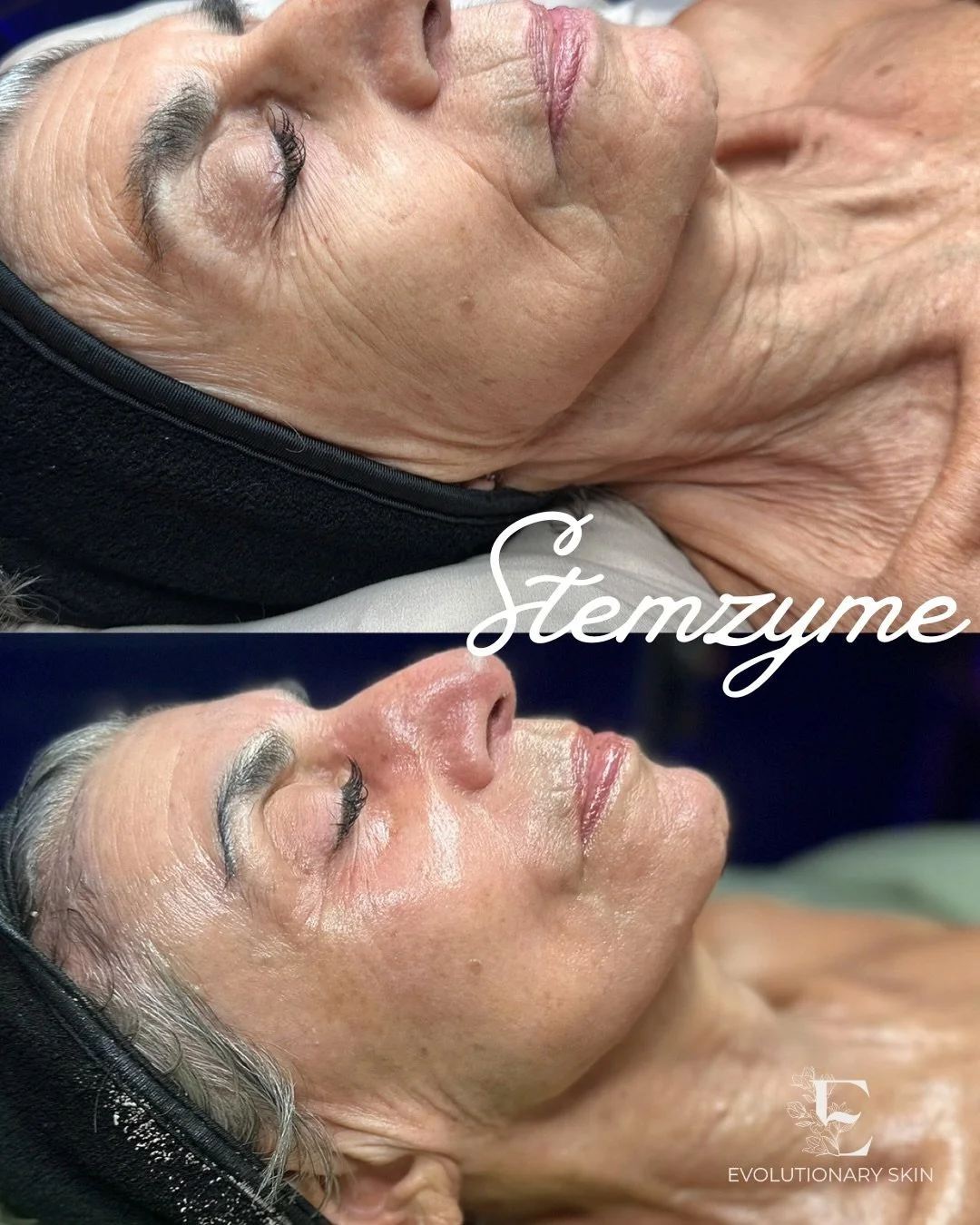 Would you believe me if I told you these photos were taken only 50 days apart with NO injectables, fillers, lasers, or peels, and JUST by stimulating her skin&rsquo;s stem cells to repopulate? (even at 82!) 
This is the magic of DMK StemZyme - a new 