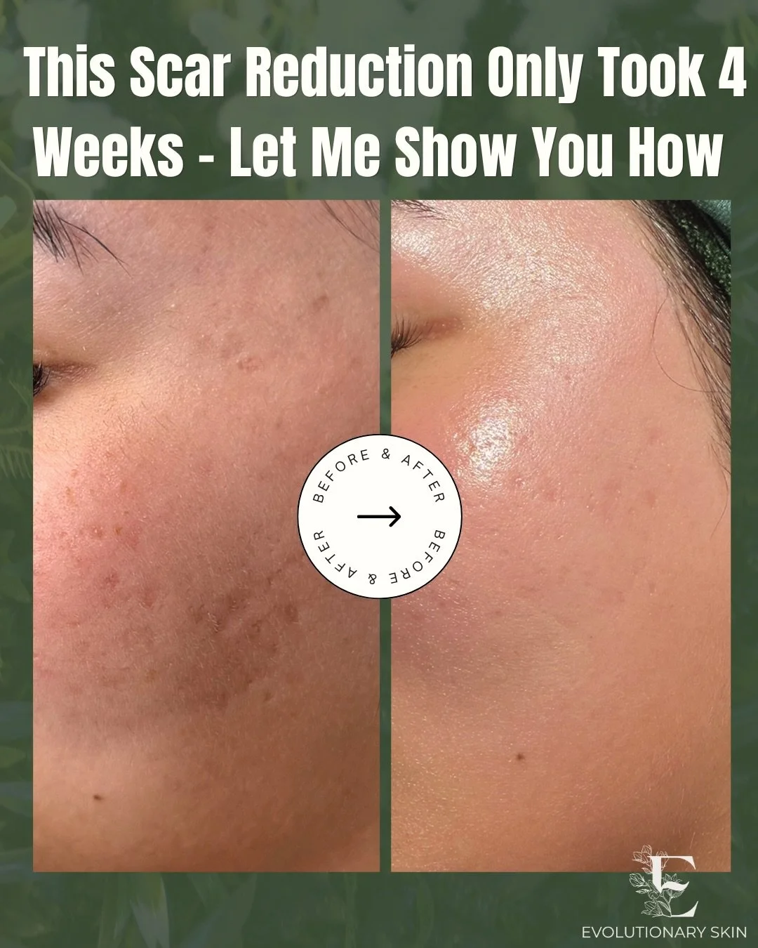 Not all scar revision takes forever. But fast progress usually doesn&rsquo;t happen by accident. It happens with a plan! 

This client saw a big shift in just 4 weeks, and one of the biggest reasons is that we weren&rsquo;t starting from zero. Her ac