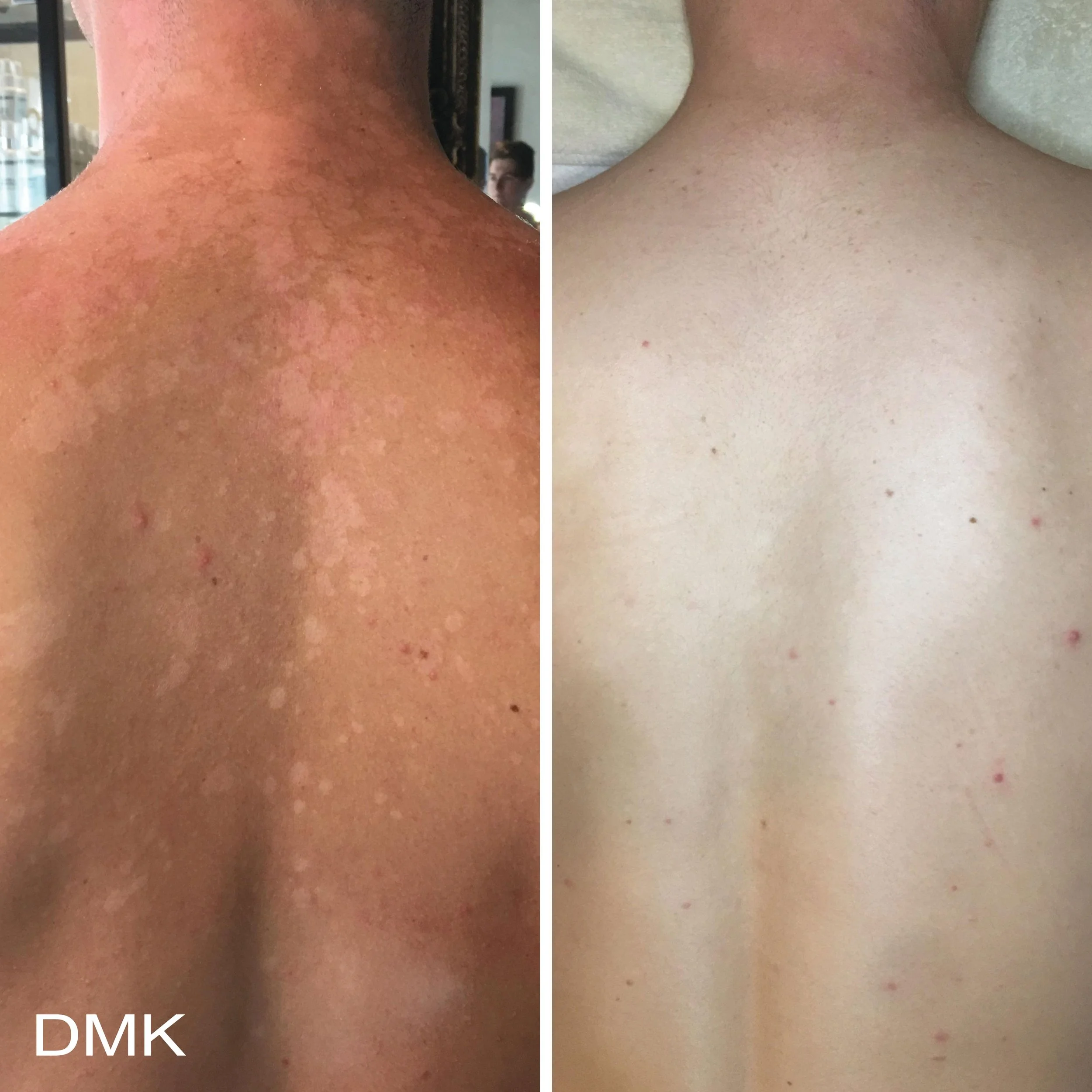 body enzyme therapy tinea versicolor in Reseda, CA