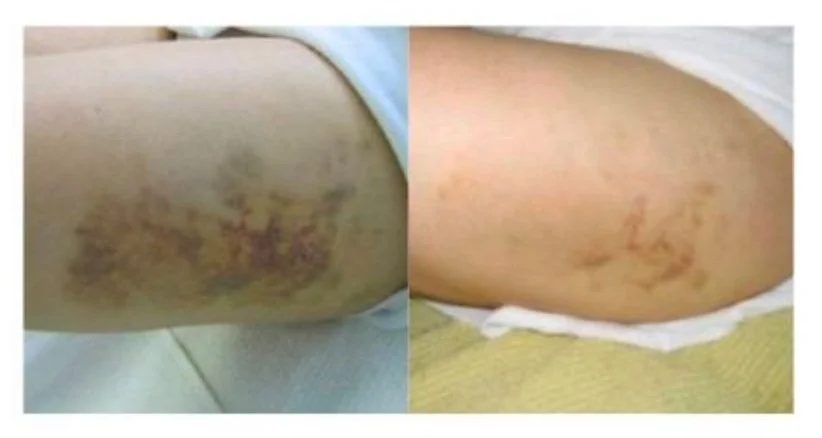 Heal the Skin and Encourage Healing after liposuction with DMK enzyme therapy in Reseda, CA
