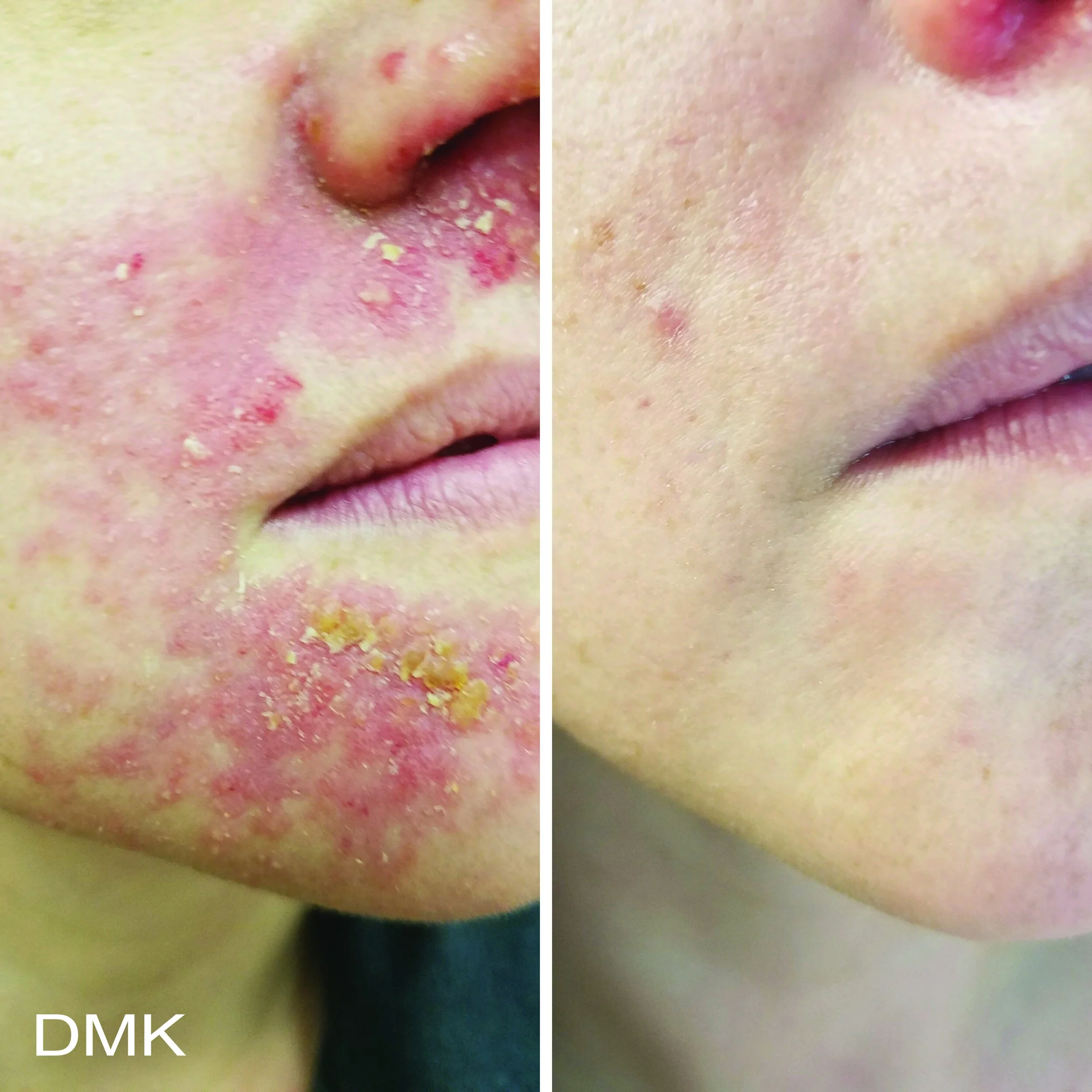 Renew Reactive Skin in Reseda, CA