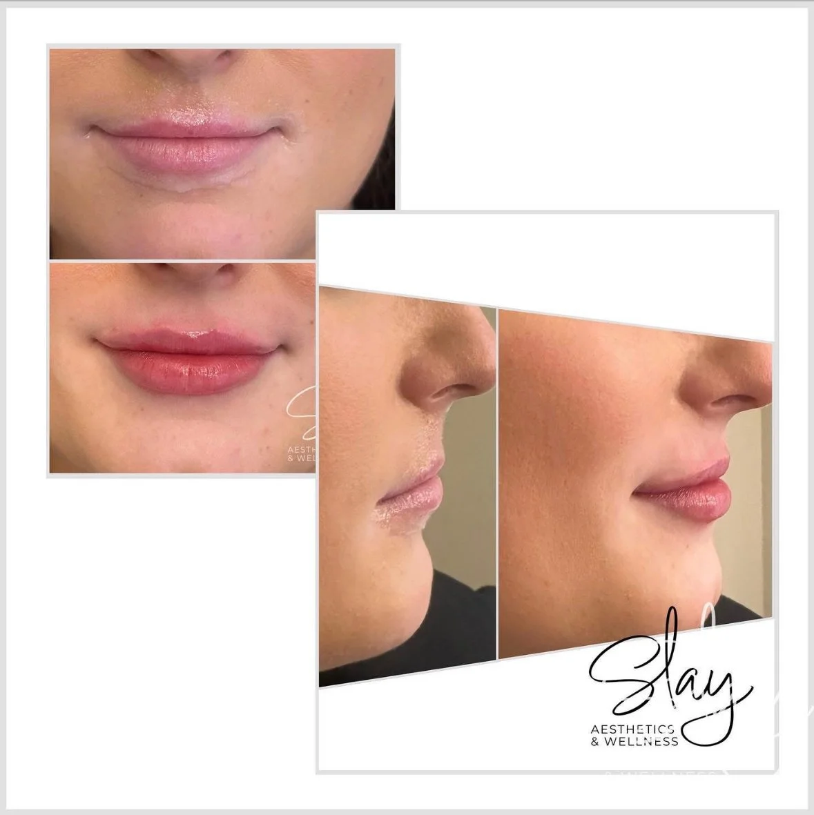 Lip Filler by Heather