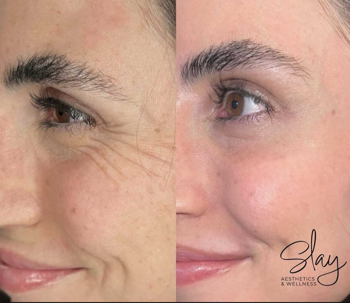 Botox by Heather