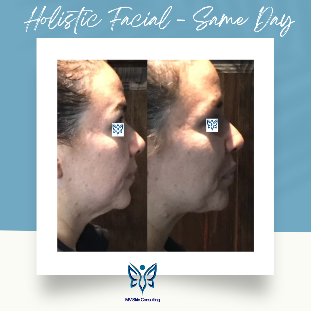Holistic Facial – Same Day: Side-by-side comparison showing visibly improved skin tightness and texture by MV Skin Consulting in Collin County, Texas.
