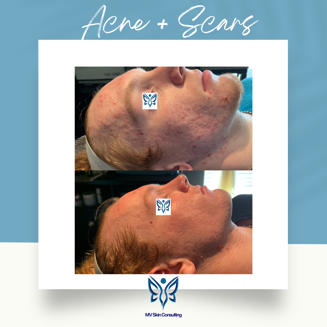 Acne and Scars Transformation: Clearer, smoother skin achieved naturally with holistic facials at MV Skin Consulting, Dallas, Texas