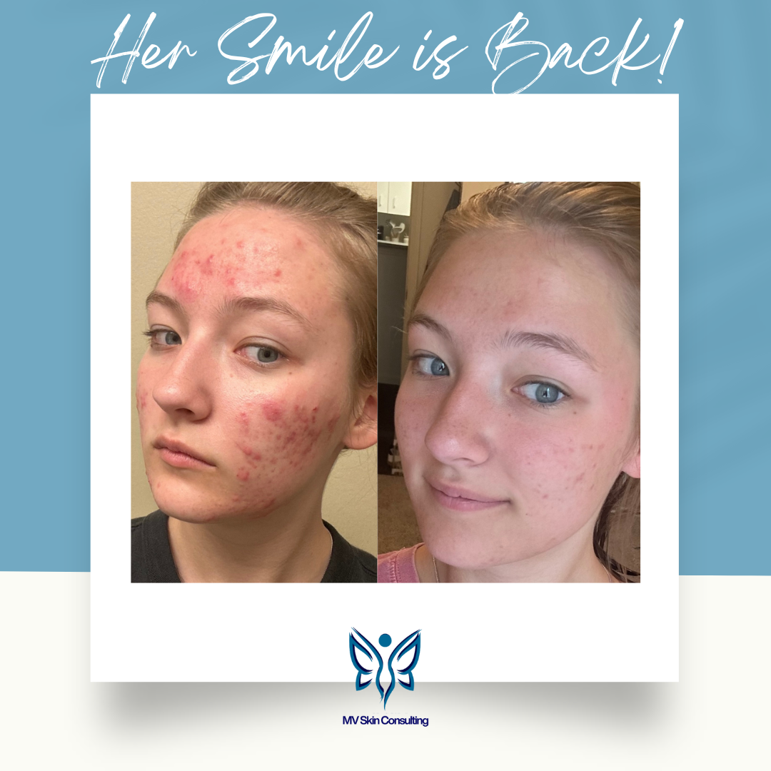 Teen acne progress pictures at MV Skin Consulting, natural and holistic facials without harsh products, pain, or downtime. Serving DFW