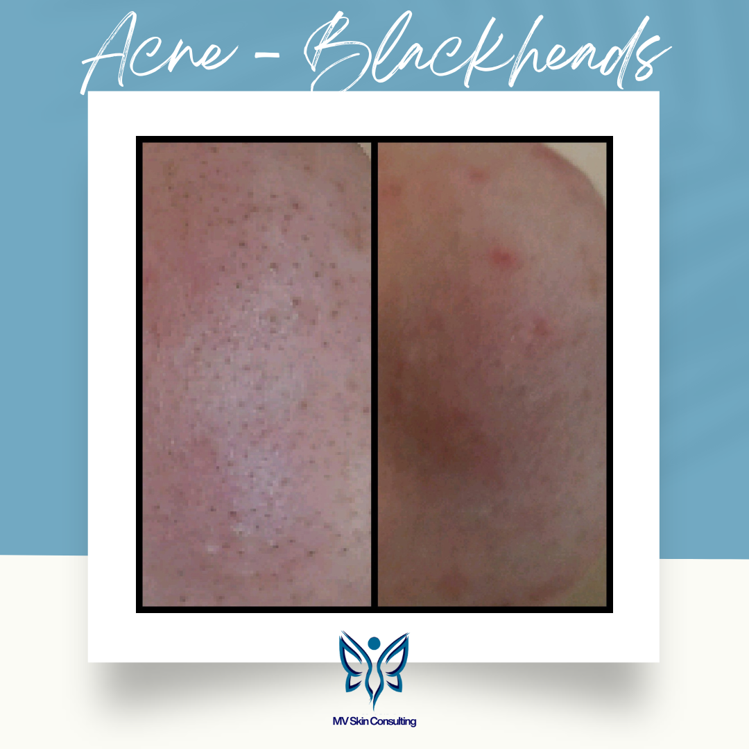 Noticeable reduction of blackheads on the nose after MV Skin Consulting's natural teen acne facial program serving Dallas and Collin counties in Texas