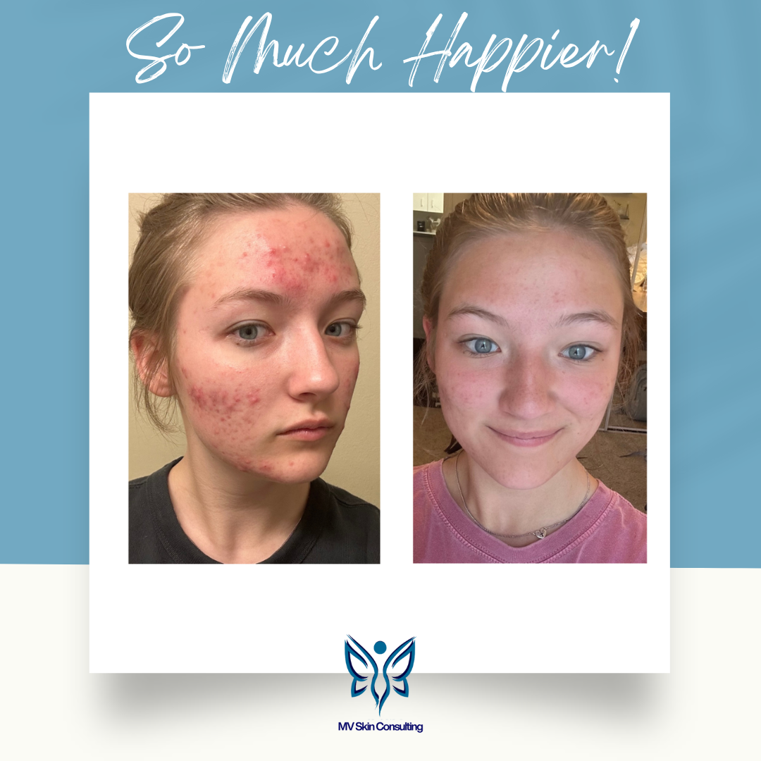 Say Goodbye to Teen Acne with Gentle, Natural Facials for Lasting Results at MV Skin Consulting without downtime or skin sensitivity, serving DFW.