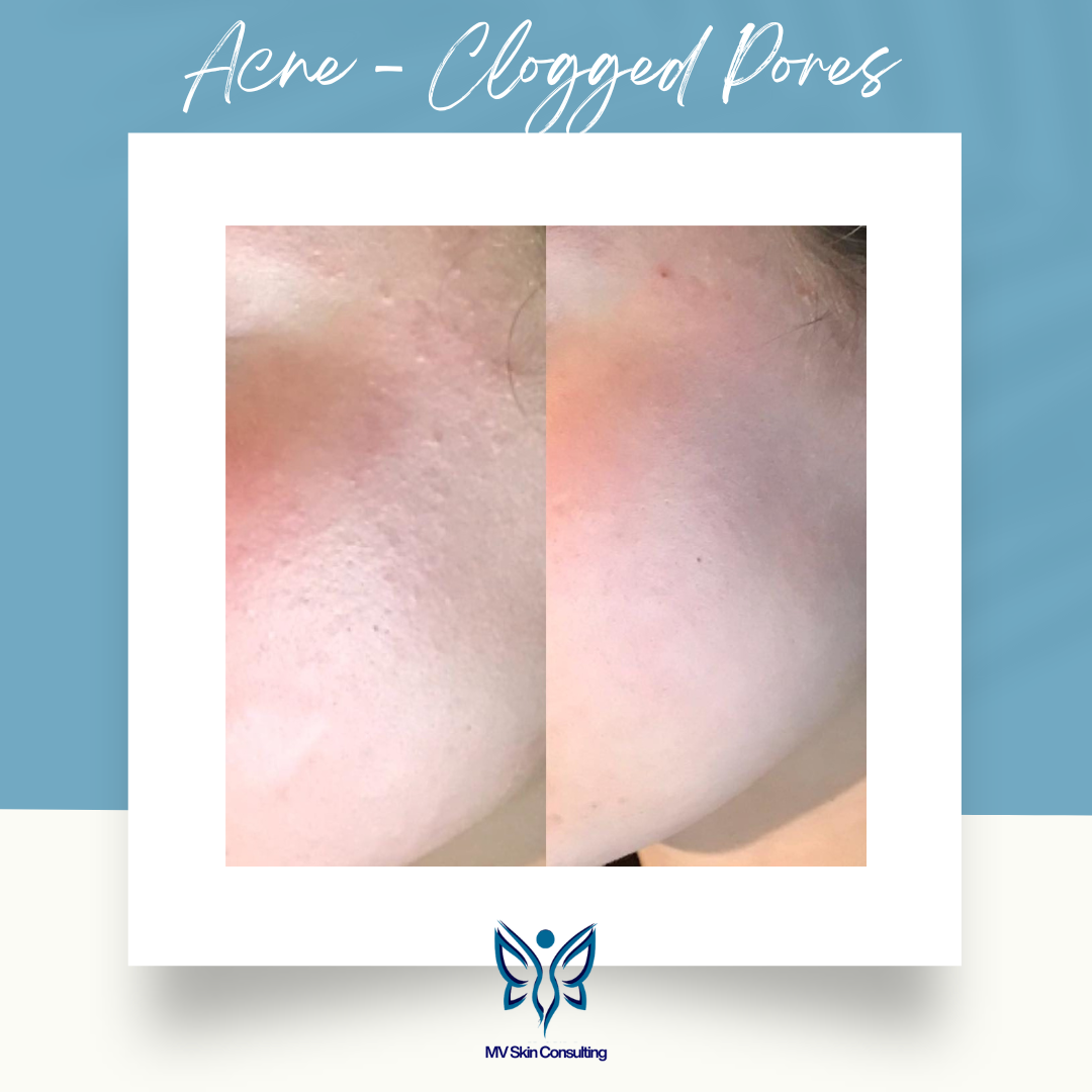 Before & After: natural teen acne facial showing clearer, smoother skin with reduced clogged pores after MV Skin Consulting treatment in Plano, TX