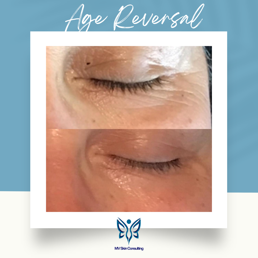 “Before and after: Same-day results on crow’s feet with a holistic facial using natural skincare at MV Skin Consulting, proudly serving Collin and Dallas counties in Texas.”