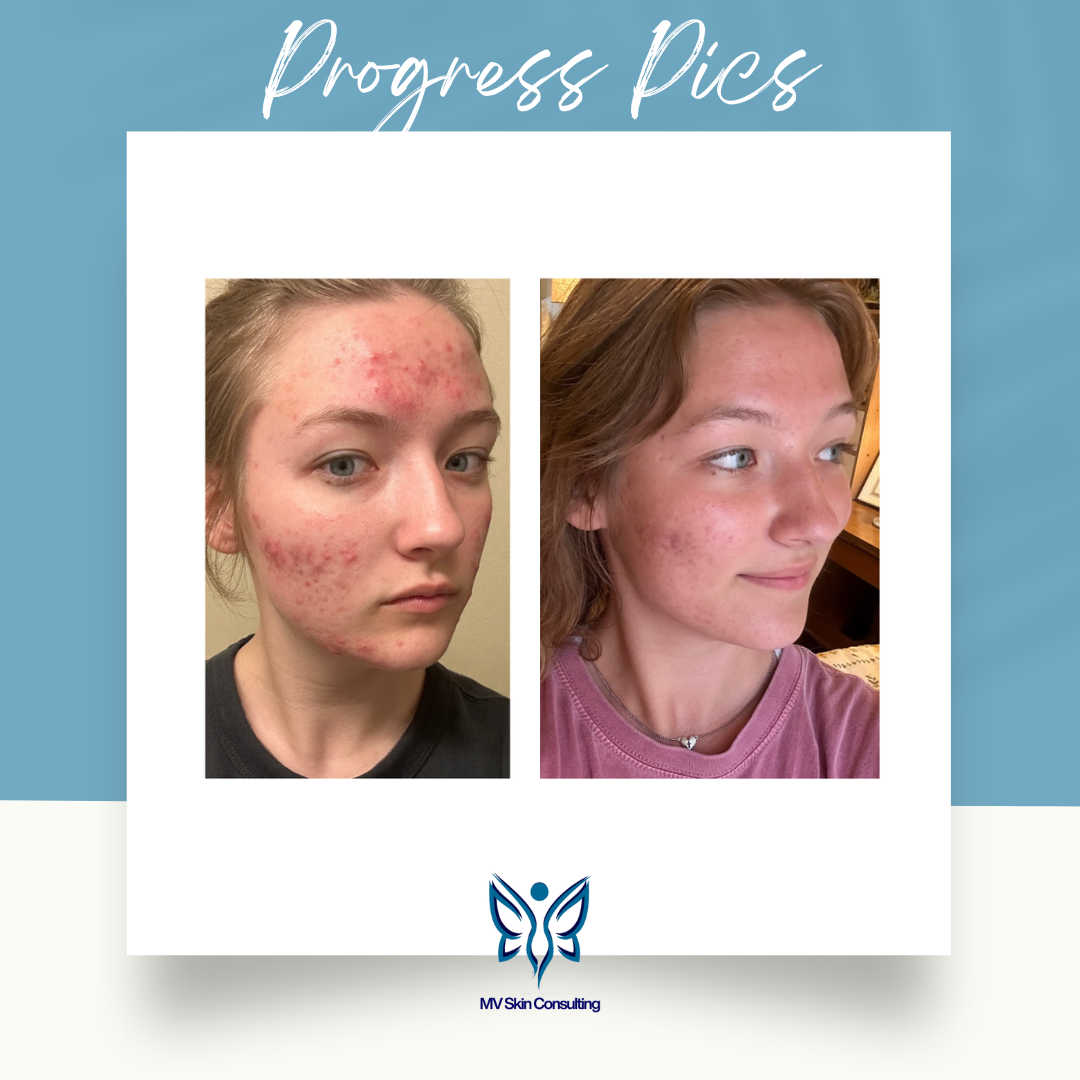 Transforming Teen’s Skin Naturally with Targeted Acne Facials at MV Skin Consulting, Teen Acne Plano