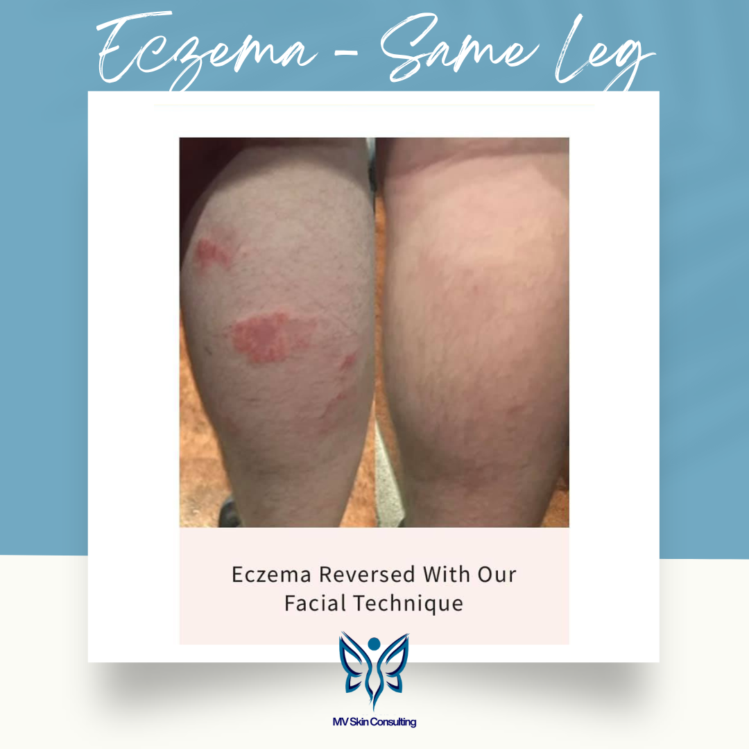 Eczema reversed without treating the leg.  MV Skin Consulting's holistic facial technique works on all of the skin, not just the face. In DFW.