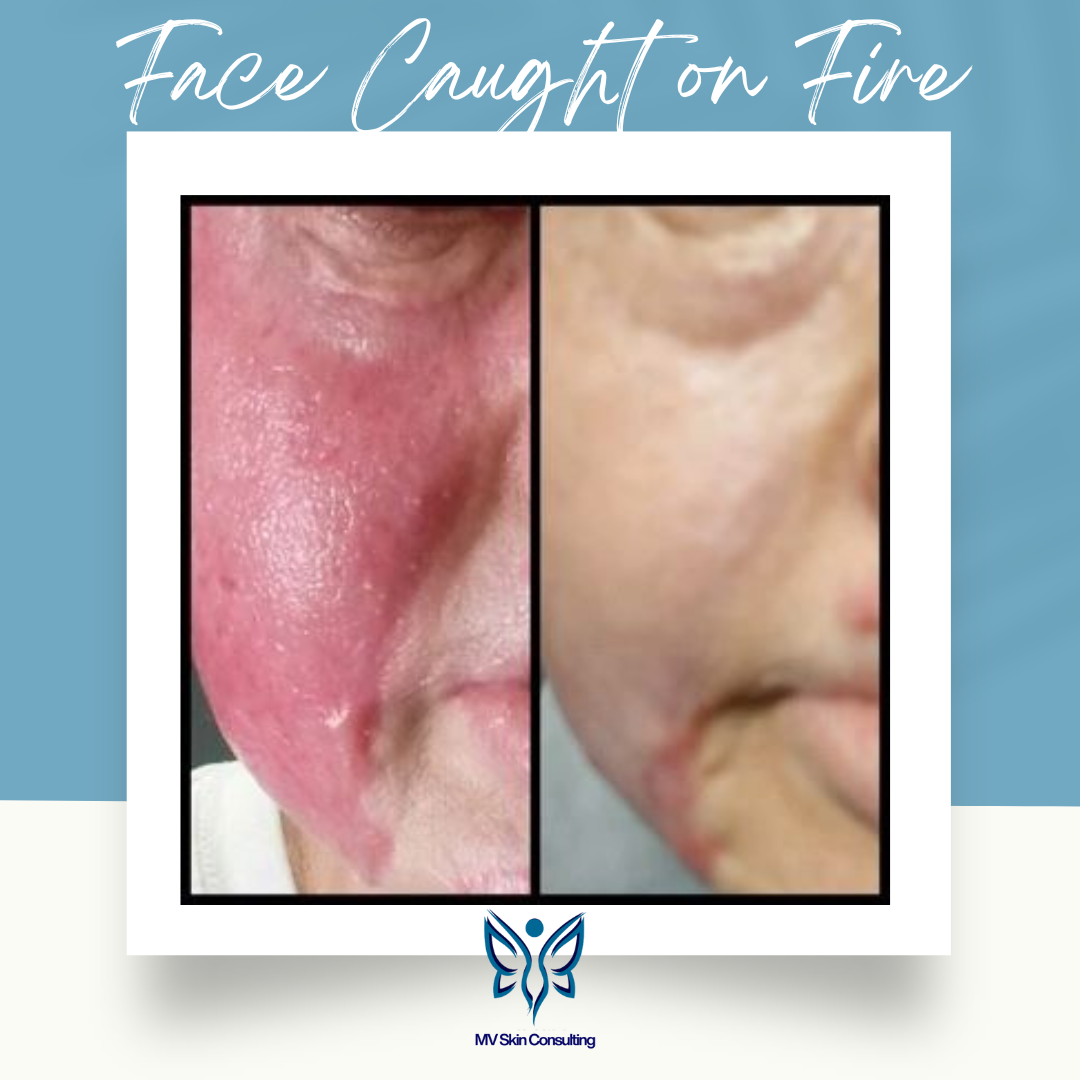 Before & After: Natural facials helped calm severe burns after an accident, redness and irritation, restoring clear, healthy skin by MV Skin Consulting