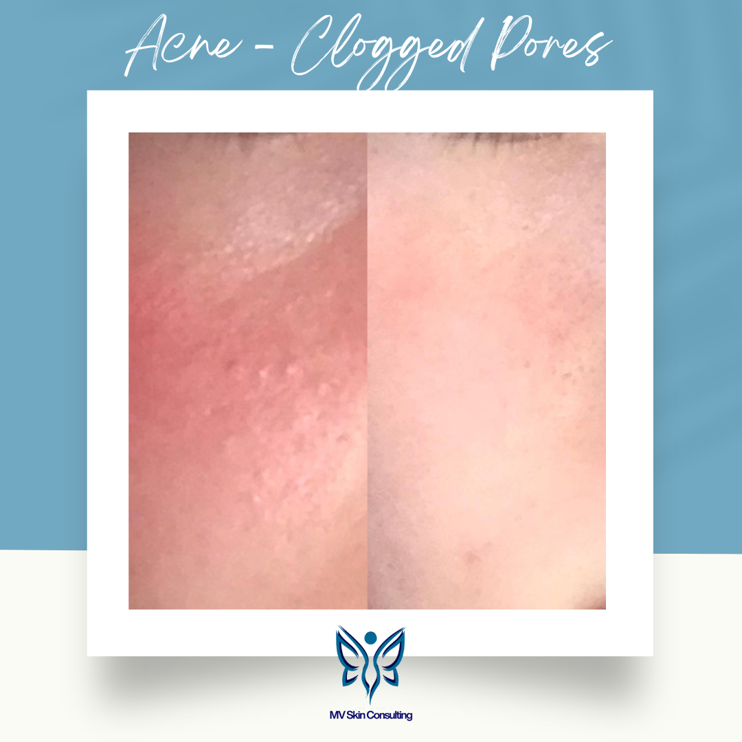 Teen Acne Cleared Naturally: Gentle, Effective Facials for Healthy Skin at MV Skin Consulting, Collin and Dallas Counties in Texas