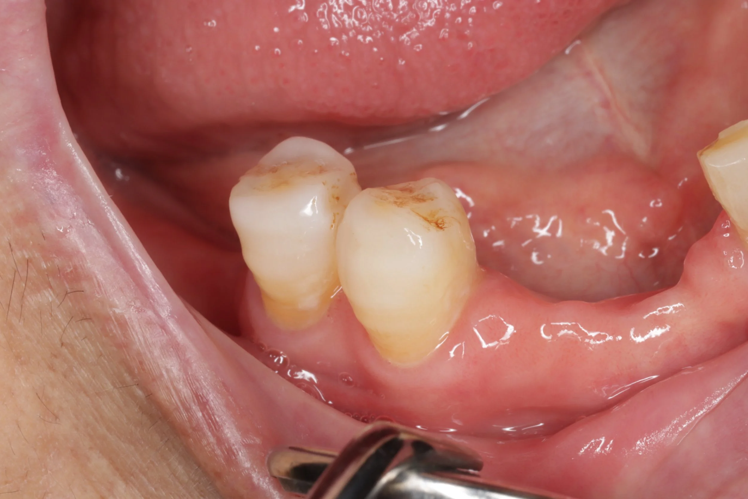 A close-up of a person's mouth showing two molars with decay or staining on the chewing surfaces, and a dental instrument near the gums.