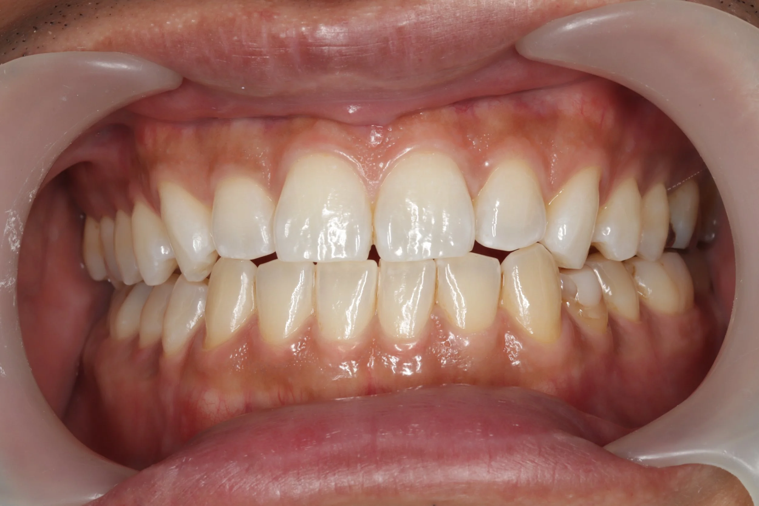 A close-up view of a person's open mouth showing upper and lower teeth, gums, and surrounding oral tissues.