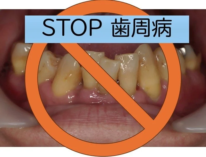Close-up of teeth with visible plaque and tartar buildup, side profile of a mouth with a 'stop' sign overlay and Chinese characters indicating dental disease.